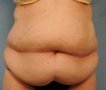 Tummy Tuck (Abdominoplasty)