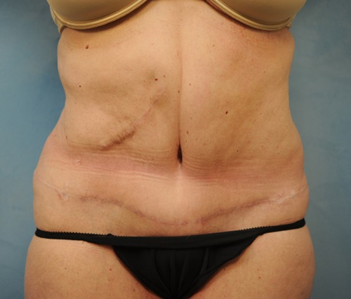 Tummy Tuck (Abdominoplasty)