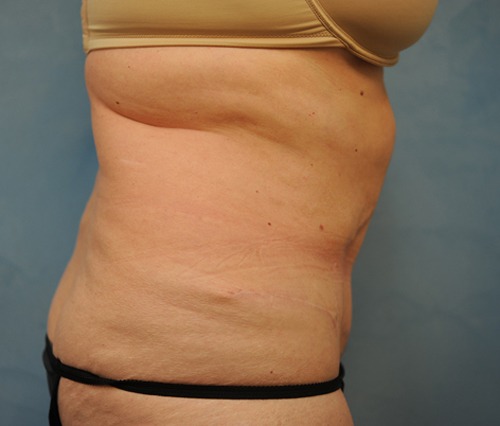 Tummy Tuck (Abdominoplasty)