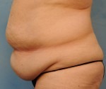 Tummy Tuck (Abdominoplasty)