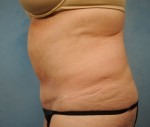 Tummy Tuck (Abdominoplasty)