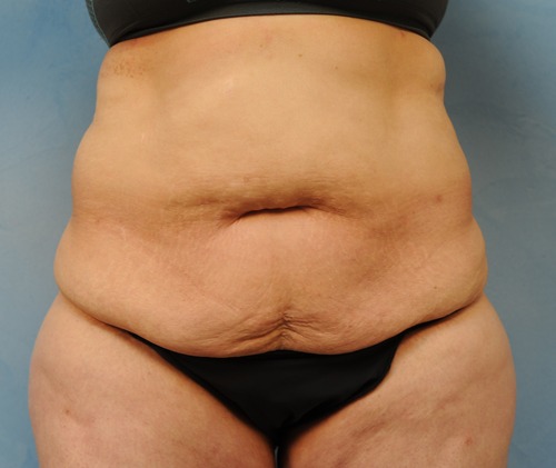 Tummy Tuck (Abdominoplasty)