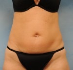 Tummy Tuck (Abdominoplasty)