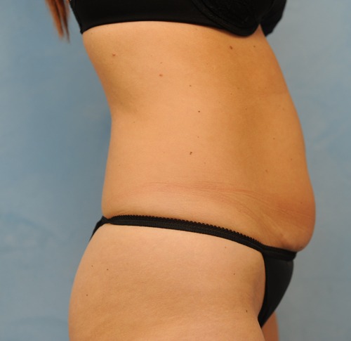 Tummy Tuck (Abdominoplasty)