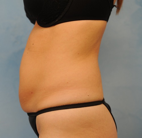 Tummy Tuck (Abdominoplasty)