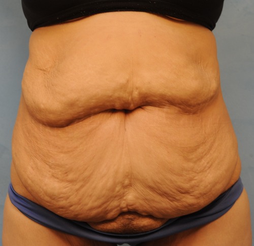 Abdominoplasty Photo Gallery