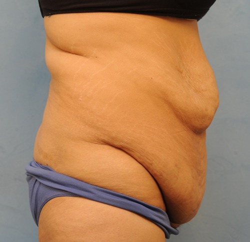 Tummy Tuck (Abdominoplasty)