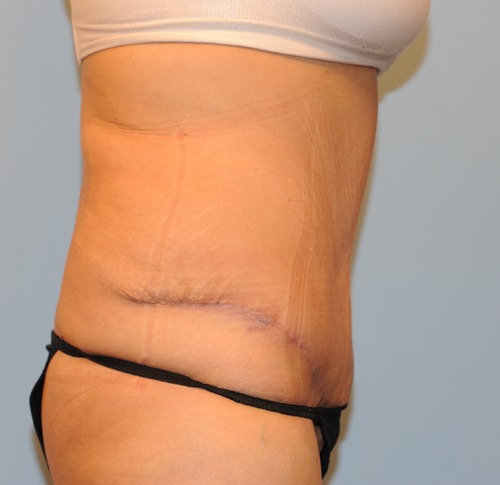 Tummy Tuck (Abdominoplasty)