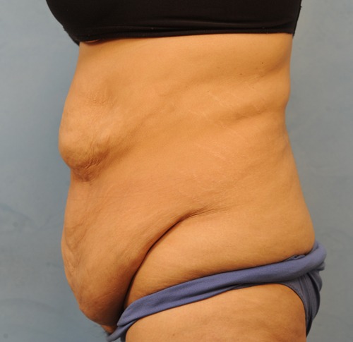 Tummy Tuck (Abdominoplasty)