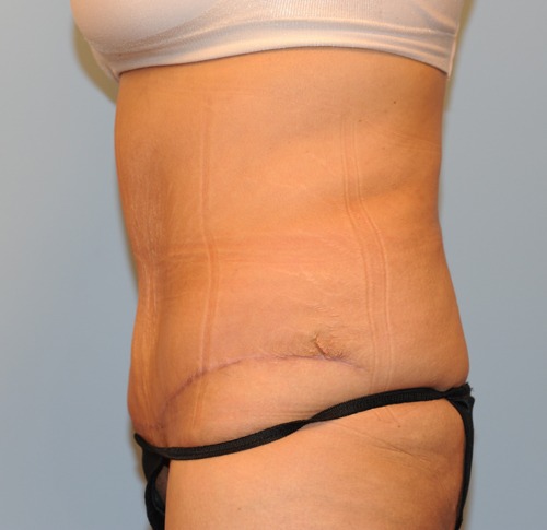 Tummy Tuck (Abdominoplasty)