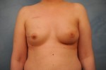 Breast Reconstruction