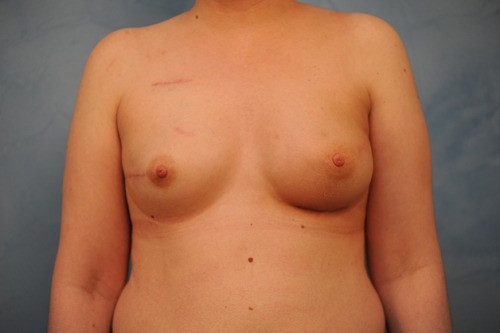 Breast Reconstruction