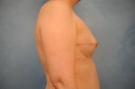 Breast Reconstruction