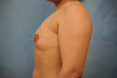 Breast Reconstruction