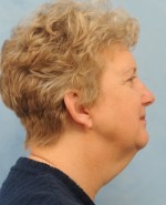 Facelift (Rhytidectomy)