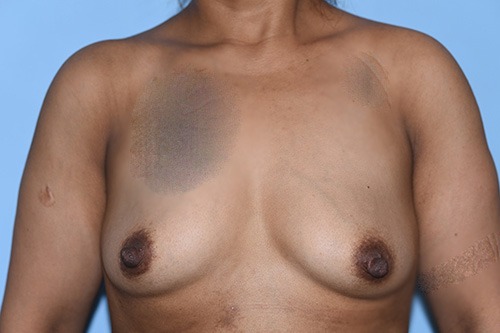 Silicone Breast Augmentation (Augmentation Mammoplasty)