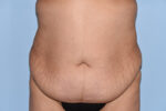 Tummy Tuck (Abdominoplasty)