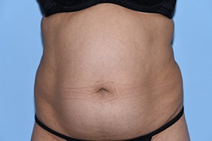 Tummy Tuck (Abdominoplasty)