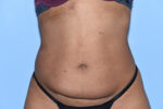 Tummy Tuck (Abdominoplasty)