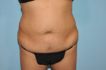 Tummy Tuck (Abdominoplasty)