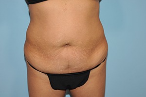 Tummy Tuck (Abdominoplasty)