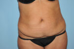 Tummy Tuck (Abdominoplasty)