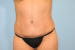 Tummy Tuck (Abdominoplasty)