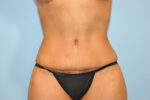 Tummy Tuck (Abdominoplasty)