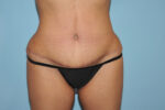 Tummy Tuck (Abdominoplasty)