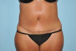 Tummy Tuck (Abdominoplasty)