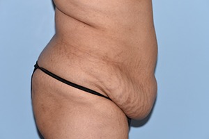 Tummy Tuck (Abdominoplasty)