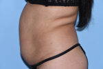 Tummy Tuck (Abdominoplasty)