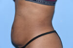 Tummy Tuck (Abdominoplasty)