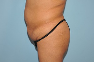 Tummy Tuck (Abdominoplasty)