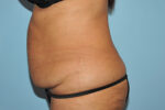 Tummy Tuck (Abdominoplasty)