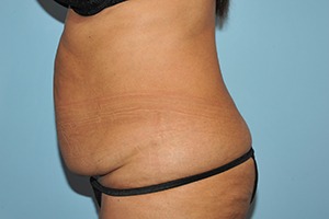 Tummy Tuck (Abdominoplasty)