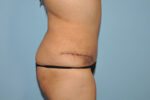 Tummy Tuck (Abdominoplasty)