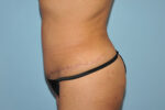 Tummy Tuck (Abdominoplasty)