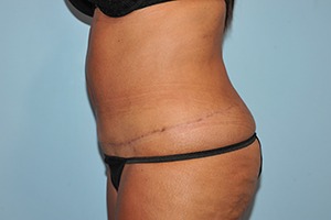 Tummy Tuck (Abdominoplasty)