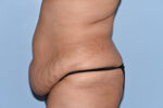 Tummy Tuck (Abdominoplasty)