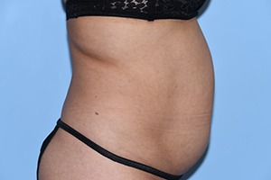 Tummy Tuck (Abdominoplasty)