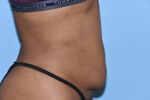 Tummy Tuck (Abdominoplasty)