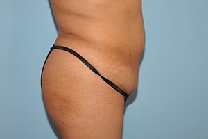 Tummy Tuck (Abdominoplasty)