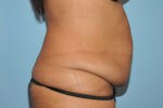 Tummy Tuck (Abdominoplasty)