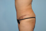 Tummy Tuck (Abdominoplasty)