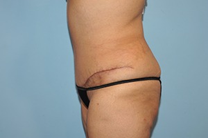 Tummy Tuck (Abdominoplasty)