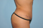 Tummy Tuck (Abdominoplasty)