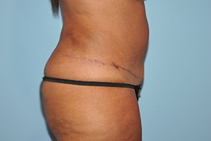 Tummy Tuck (Abdominoplasty)