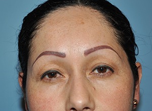 Upper and Lower Eye Lift (Blepharoplasty)