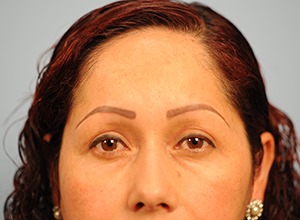 Upper and Lower Eye Lift (Blepharoplasty)